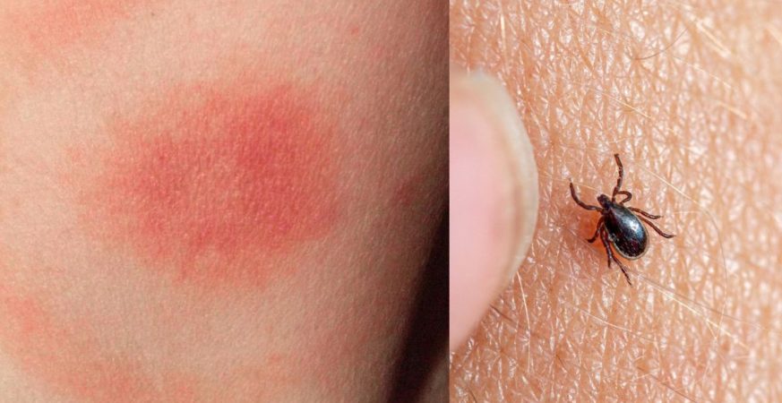 Enfermedad de Lyme es provocada por las garrapatas